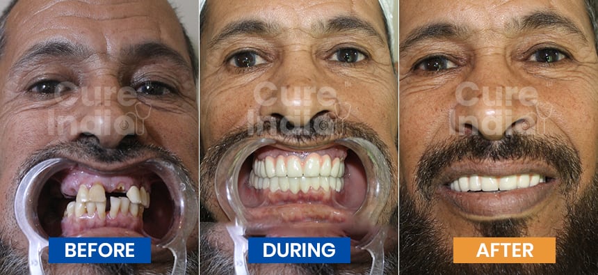 Dental Before after case